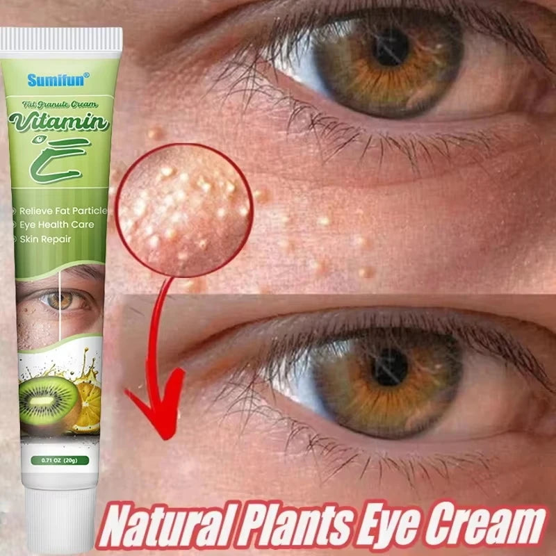 Eye Cream for Fat Granules Puffiness - Milia Remover Skin Repair - ZOOMNSTORE
