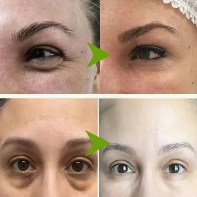 Eye Cream for Fat Granules Puffiness - Milia Remover Skin Repair - ZOOMNSTORE