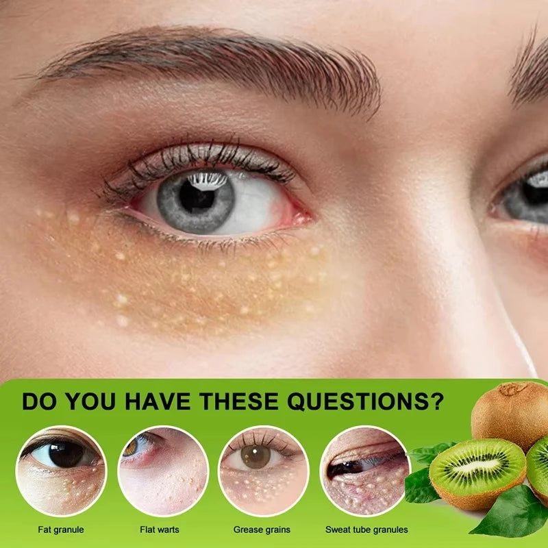 Eye Cream for Fat Granules Puffiness - Milia Remover Skin Repair - ZOOMNSTORE