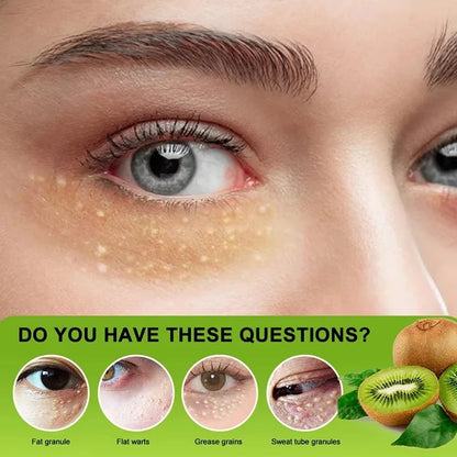 Eye Cream for Fat Granules  Puffiness - Milia Remover  Skin Repair - ZOOMNSTORE