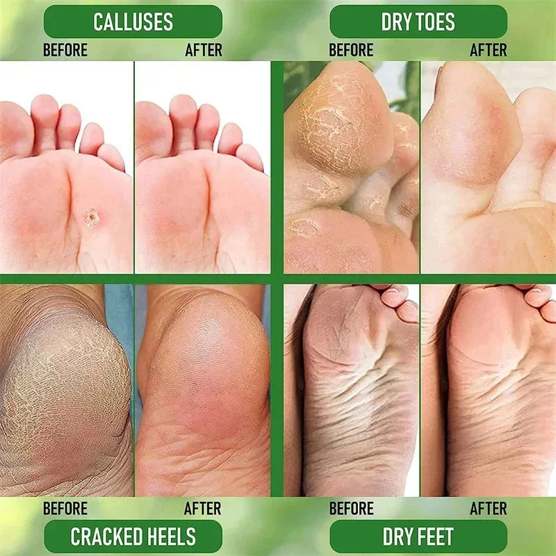 Herbal Foot Cream - Heel Cracking Repair  Dead Skin Exfoliation - ZOOMNSTORE