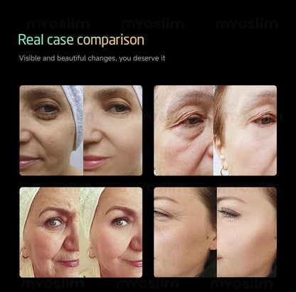 New 25D 360MAX Beauty Machine for Facial Lifting, Skin Tightening and Body Slimming Latest Salon Equipment